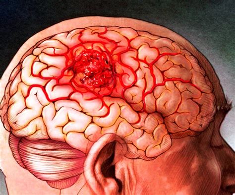 Causas de un tumor en el cerebro: Todo lo que debes saber