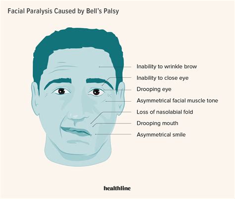 Bell’s Palsy: Causes, Symptoms, Diagnosis, Treatment, Outlook