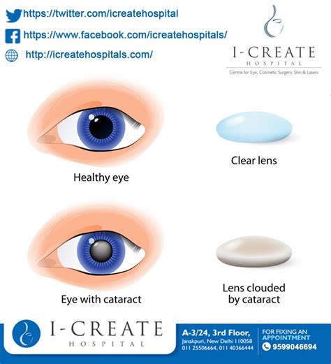 Laser Eye Surgery Color Blindness - Colorxml