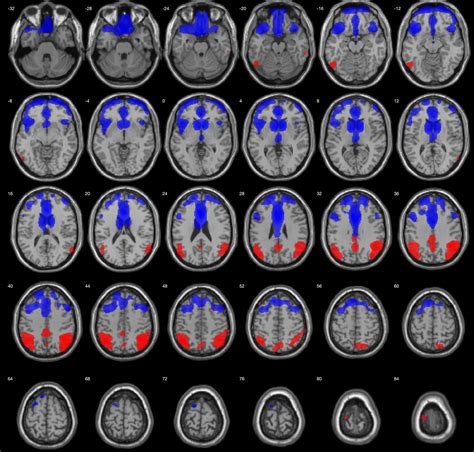 Frontiers | Genetic Algorithms for Optimized Diagnosis of Alzheimer’s ...