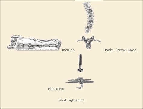 posterior approach - Modern Spine