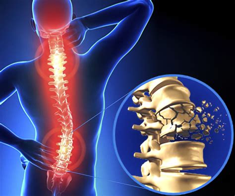 spinal-cord-injury - Medically Speaking