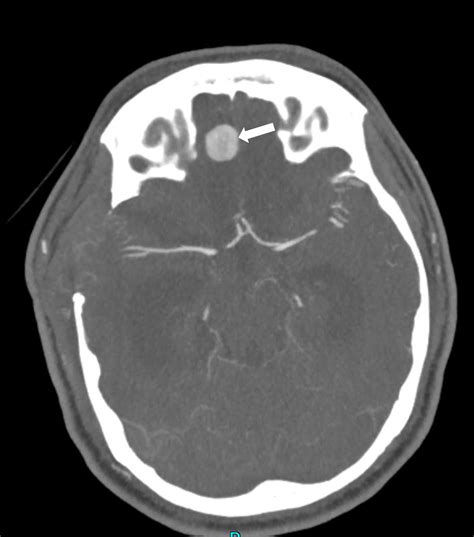 Anterior Cranial Fossa Dural Arteriovenous Fistula with Venous Varix ...