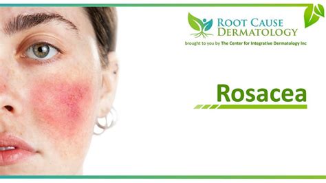 Discover The Root Cause of Rosacea | Educational Video Course