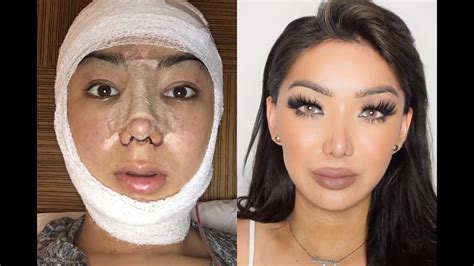 My Facial Plastic Surgery Story! | Dragun - YouTube