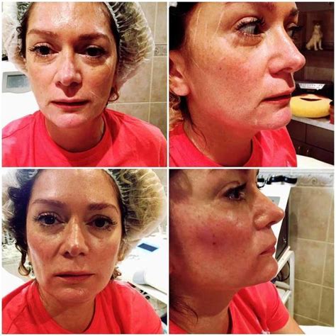 Vampire Facelift Before And After Images (5) » Facelift: Info, Prices, Photos, Reviews, Q&A