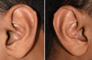 Plastic Surgery Case Study - Excision of Darwin's Tubercles of the Ears - Explore Plastic Surgery