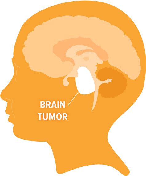 Is Stage 4 Bile Duct Cancer Terminal