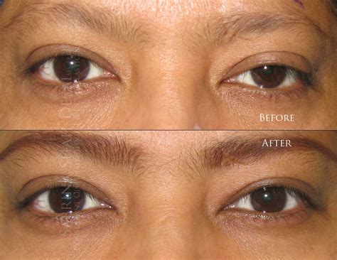 Droopy Eyelid Treatment | Ptosis Surgery in London, UK - PEL
