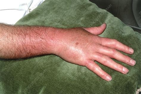 Inflammation due to cellulitis on a man's hand - Stock Image - M130 ...