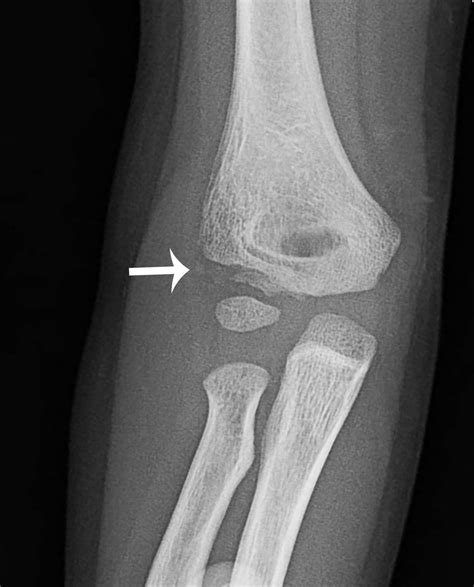 Elbow grease: Lateral and medial condyle fractures of the humerus ...