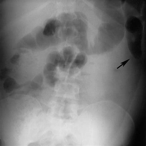 Sentinel Loop Sign In Acute Pancreatitis - In acute pancreatitis, the ...