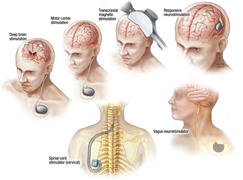 Neurostimulation Devices for the Treatment of Neurologic Disorders ...