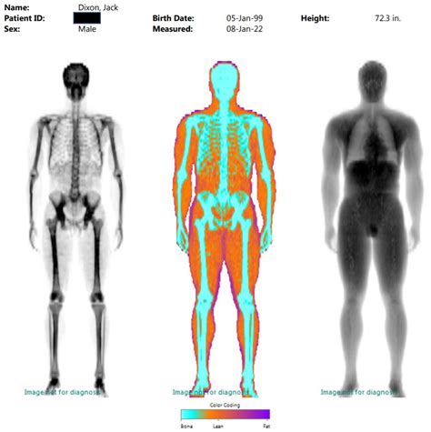 DEXA Scans: My Results & Three Elements Essential to Longevity