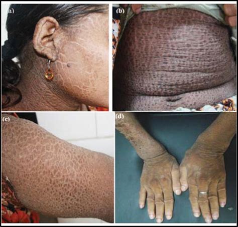 Ichthyosis: Types, Symptoms, Causes, and More