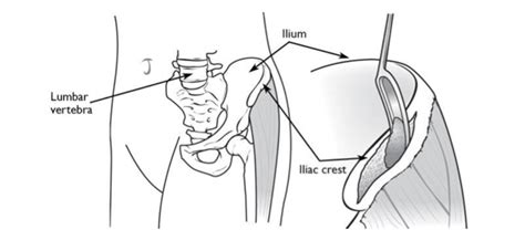 Can Iliac Crest Bone Graft Be Cheaper Than BMP? | Orthopedics This Week