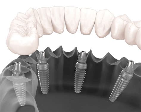 LOW COST Tooth Implants Mississauga | $2,900 Implants & Crown