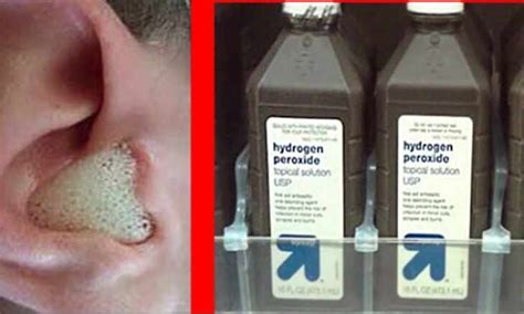 hydrogen peroxide in ear - hydrogen peroxide in ear