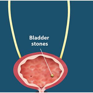 Transurethral Cystolitholapaxy Werribee | Bladder Stones Removal Melbourne VIC