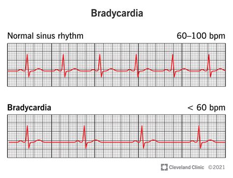 Bradycardia: Symptoms, Causes & Treatment