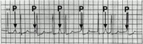 Junctional ectopic tachycardia in six paediatric patients | Heart