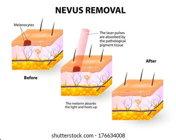 436 Melanocytic Nevus Images, Stock Photos, and Vectors | Shutterstock