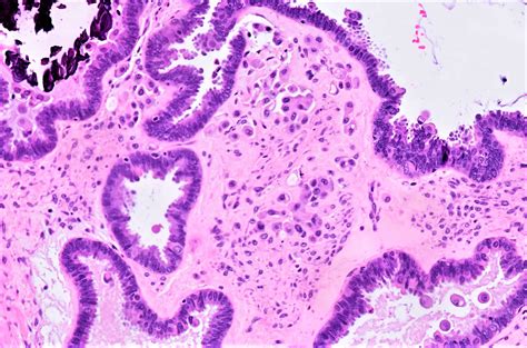 Pathology Outlines - Serous borderline tumor