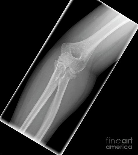 Fracture Of Elbow Bone Photograph by Science Photo Library - Fine Art America