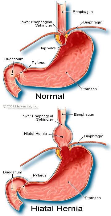 Hiatal Hernia