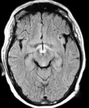 Dr Balaji Anvekar FRCR: Wernicke's Encephalopathy MRI