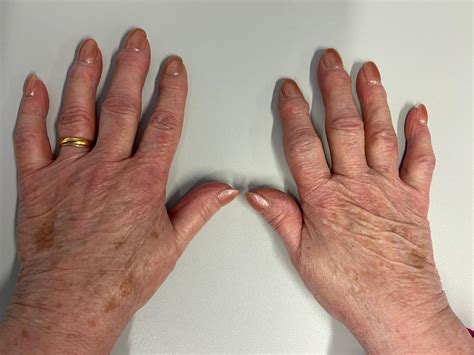 How hand osteoarthritis is associated with hand pain and function ...