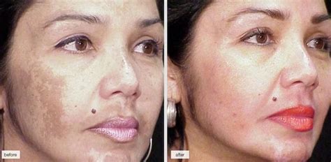 Skin Discoloration Cream – Best Prevention and Treatment Methods - ESC