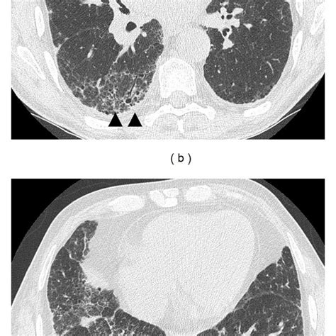 Chest X-ray of a patient diagnosed with combined pulmonary fibrosis and... | Download Scientific ...