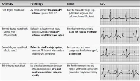 MEDICINE PAKISTAN: Heart Blocks - Types