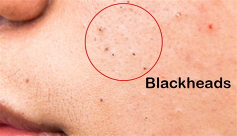 Blackheads: Causes, Symptoms, Prevention and Treatment - HealthyLopo