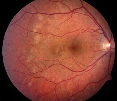 Flashes of Light in the Eyes - Medical Technology Avenue