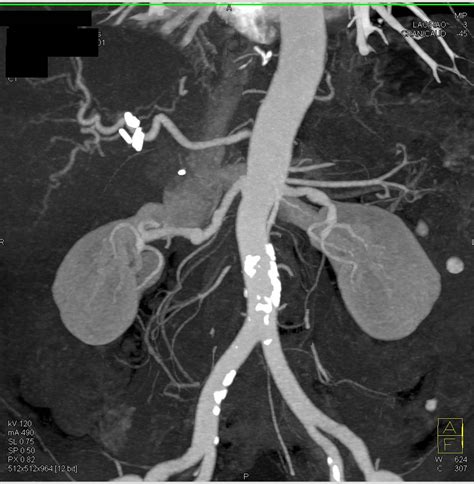 Celiac Artery Aneurysm - Vascular Case Studies - CTisus CT Scanning