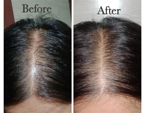 Rosemary Oil for Hair Growth Before and After Results: Here's What to