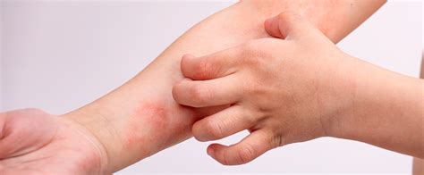 Skin diseases in comparison: neurodermatitis vs. psoriasis