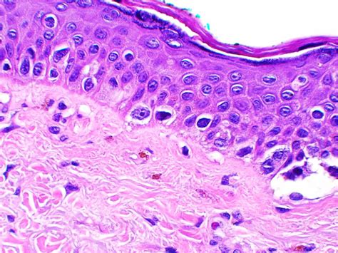 Melanoma (Malignant melanoma)