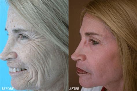 Chemical Peel - Temecula, CA | Dr. Kelly O'Neil