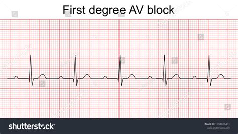 First Degree Av Block