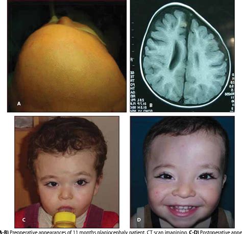 [PDF] The surgical treatment of plagiocephaly. | Semantic Scholar