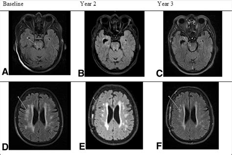 Resolution of small vessel ischemia following the pituitary adenoma... | Download Scientific Diagram