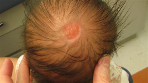 Common Birthmarks - The Clinical Advisor