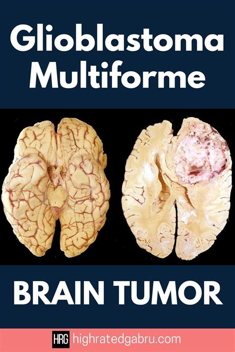 what happens in the final stages of glioblastoma - Chunky Portal Photos