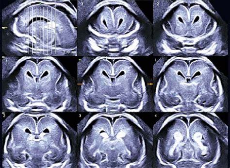 Tomographic ultrasound imaging of normal brain in coronal cutting ...