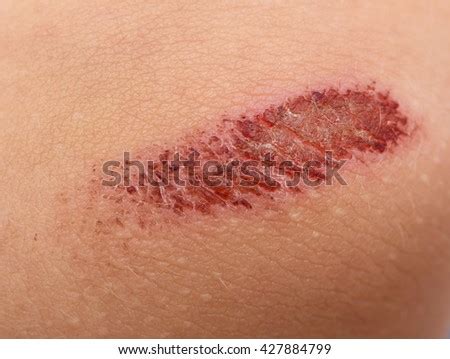 Infection Or Abrasion Of The Skin Stock Images, Royalty-Free Images & Vectors | Shutterstock