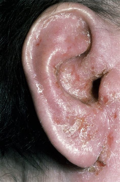 Otitis Externa Maligna Pseudomonas