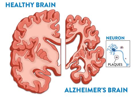 Your Brain and Alzheimer's - Fisher Center for Alzheimer's Research ...